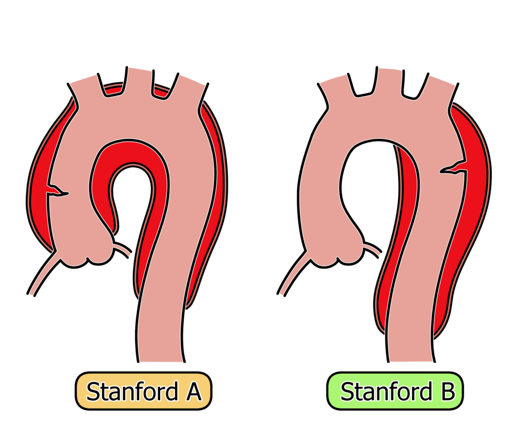 A diagram showing the difference between Stanford A and Stanford B aortic dissection
