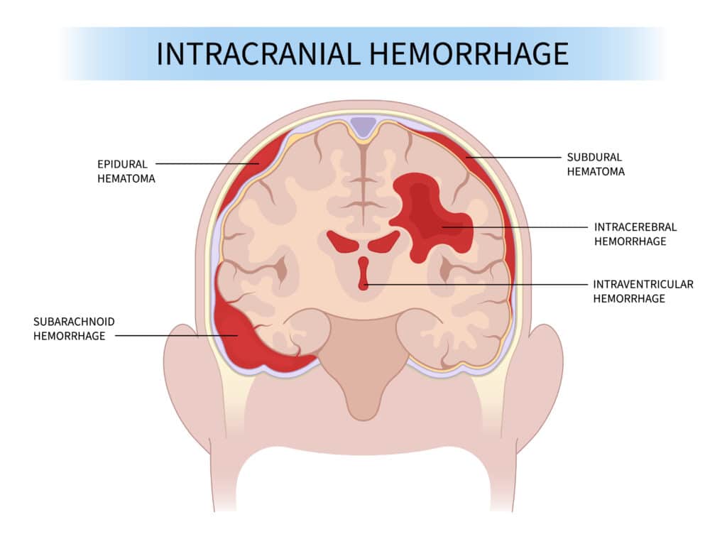 A diagram showing what intracranial hemorrhaging looks like