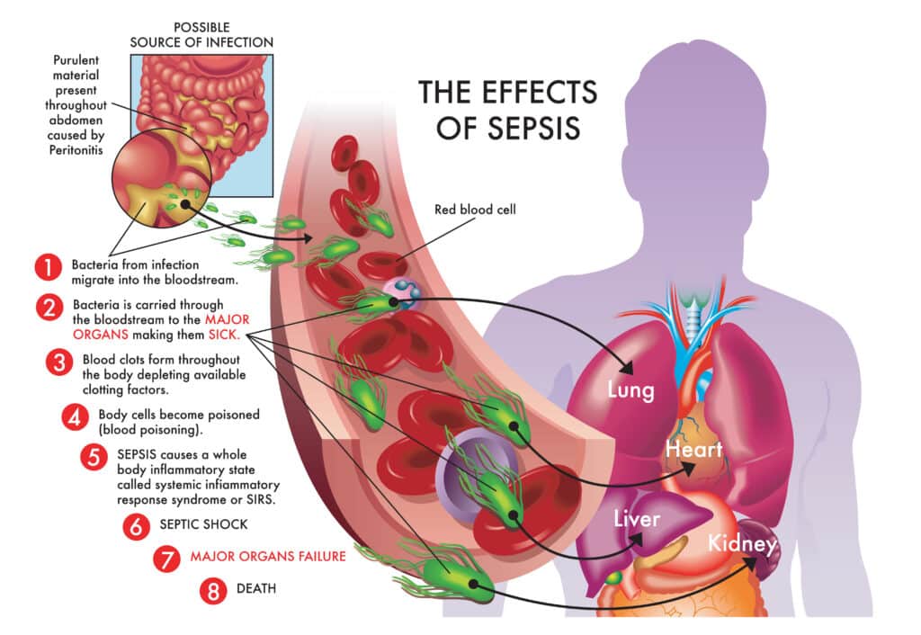 A medical illustration describing the effects of sepsis and how it's caused by bacteria from an infection migrating into the blood stream, causing blood clots and blood poisoning.