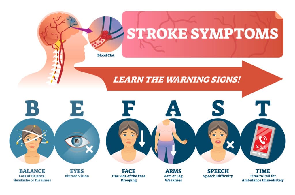 A diagram showing the B E FAST stroke symptoms