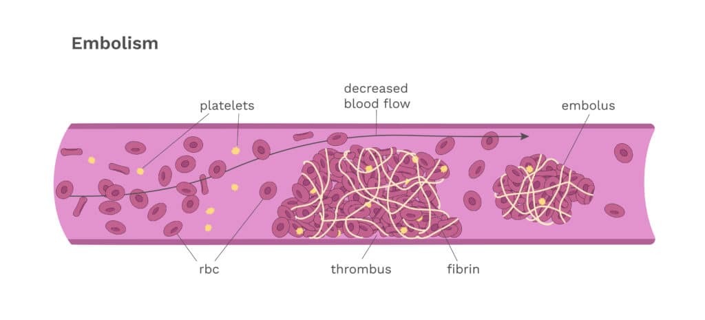 A diagram showing a blood clot and how individual blood platelets move in a vessel when there's a blood clot